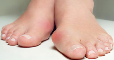 lady suffering from bunions on her feet